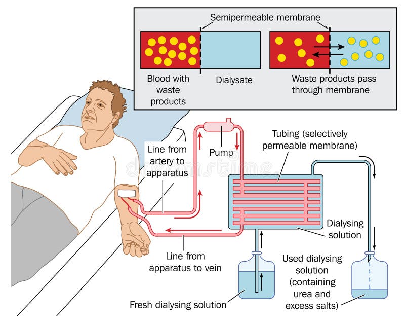 dialyse-vektor-abbildung-illustration-von-maschine-menschlich-44257508