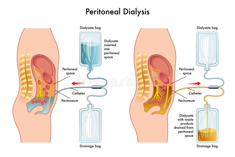 Dialyse péritonéale illustration libre de droits Dialyse péritonéale illustration libre de droits