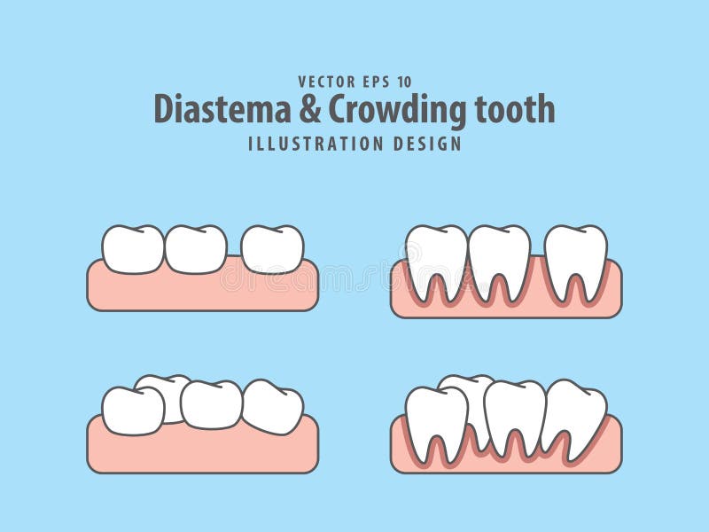 Diastema & Crowding tooth illustration vector on blue background stock illustration