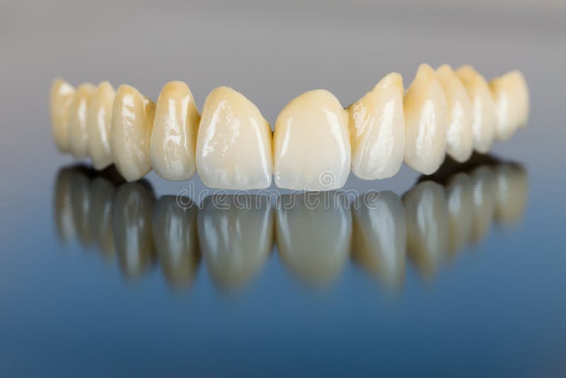 Dientes de la porcelana - puente dental
