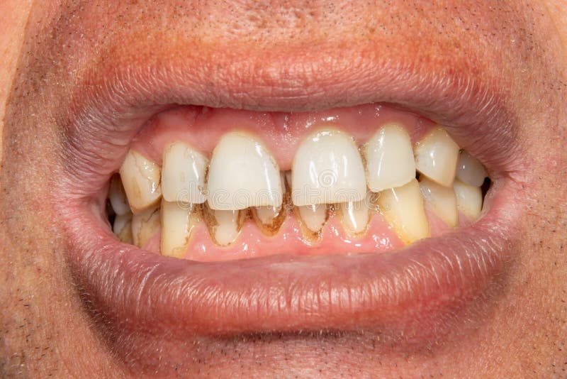 Dientes humanos con la placa y el t?rtaro que fuman Macro del primer en cl?nica dental Huevo en tocador foto de archivo Dientes humanos con la placa y el t?rtaro que fuman Macro del primer en cl?nica dental Huevo en tocador foto de archivo
