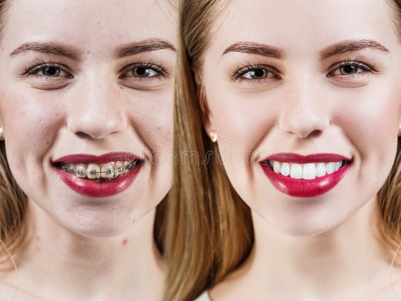 Dientes Perfectos Antes Y Después De Apoyos Imagen de archivo - Imagen