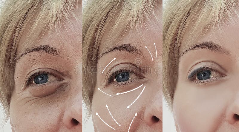Diferencia paciente madura antes y después de procedimientos cosméticos, flecha de las arrugas del tratamiento facial adulto feme fotografía de archivo Diferencia paciente madura antes y después de procedimientos cosméticos, flecha de las arrugas del tratamiento facial adulto feme fotografía de archivo
