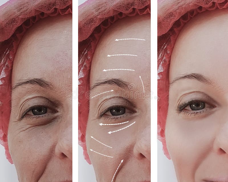 Diferencia paciente madura antes y después de procedimientos, flecha del rejuvenecimiento facial adulto femenino de las arrugas imágenes de archivo libres de regalías Diferencia paciente madura antes y después de procedimientos, flecha del rejuvenecimiento facial adulto femenino de las arrugas imágenes de archivo libres de regalías