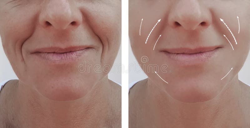 Diferença paciente antes e depois dos procedimentos, seta do enchimento adulto fêmea do elevador do contraste da dermatologia da