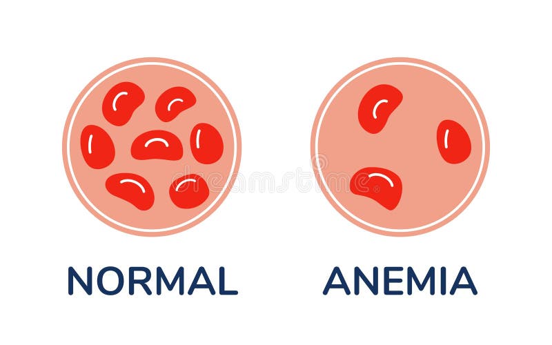 The Difference Comparison of a Drop of Blood with Normal and Anemic