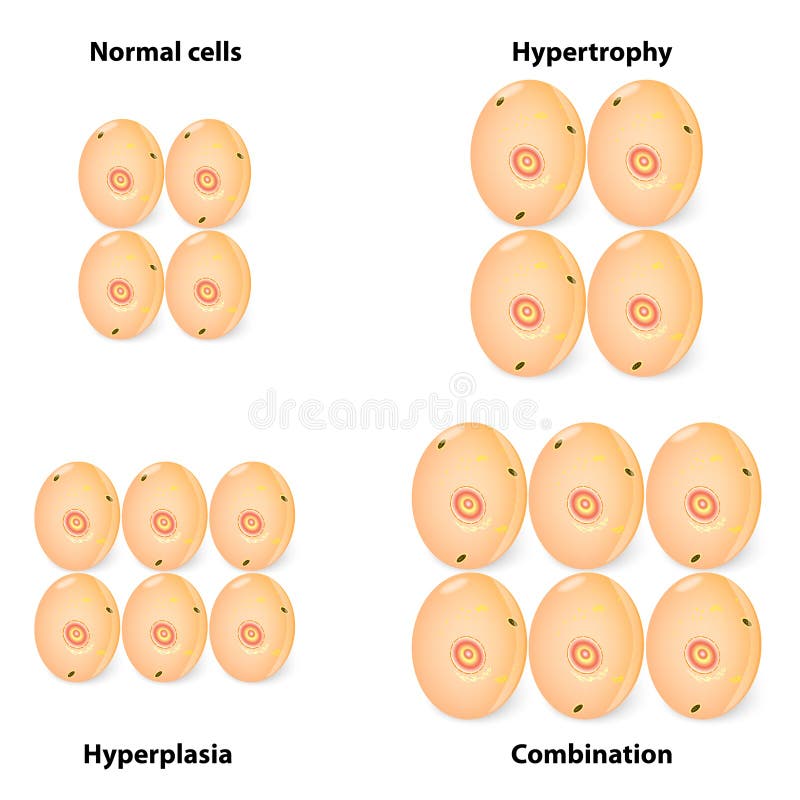 Hyperplázia, hypertrofia a normálnych buniek.