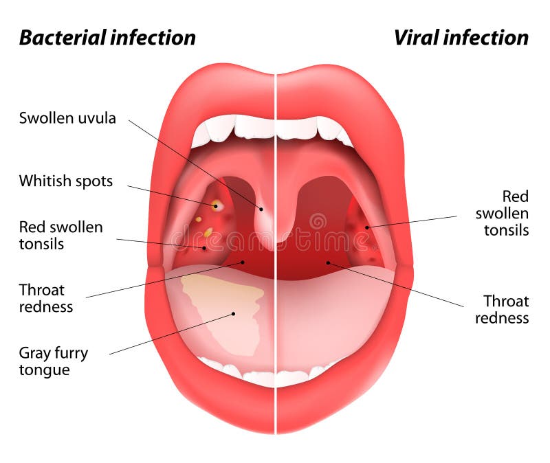 The differences between viral and bacterial infections vector illustration