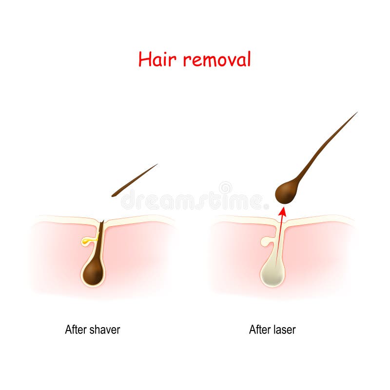 Cross Section of the Hair and Skin after Shaving or Wax, and after Laser Hair  Removal Stock Vector - Illustration of hair, care: 198063966