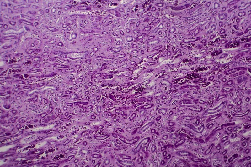 Diffuse Proliferative Glomerulonephritis Stock Photo Image of kidney