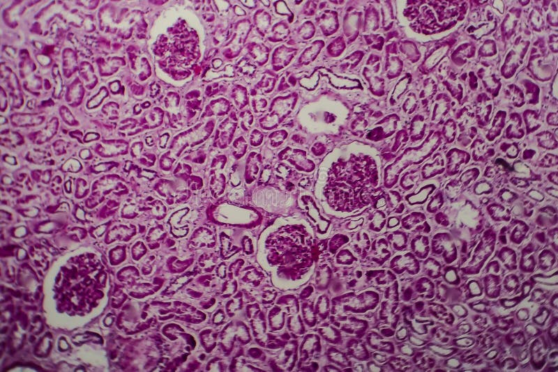 Diffuse Sclerosing Glomerulonephritis Stock Image Image of diffuse