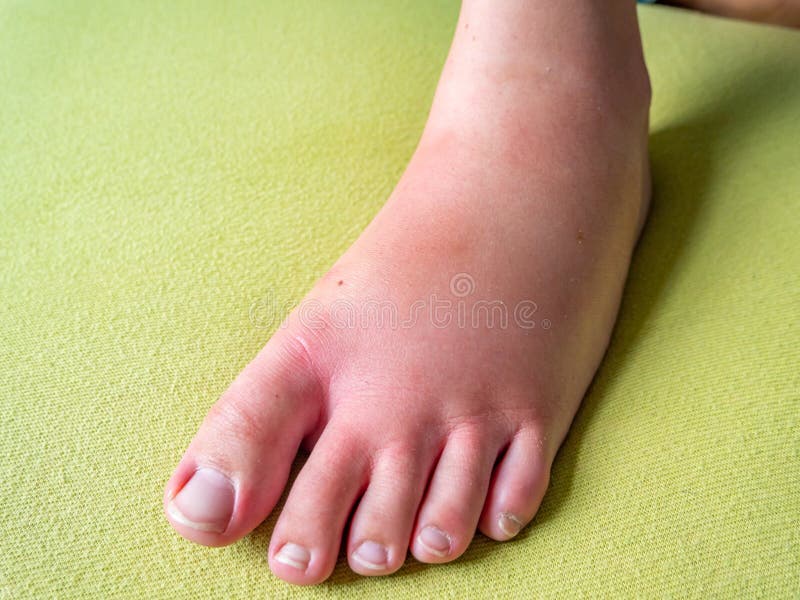 Dikke voet na insectenbeet royalty-vrije stock afbeeldingen