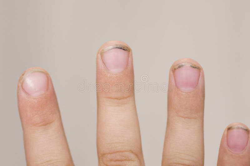 Ridges in Fingernails: Here's What Causes Ridges in Nails - Parade