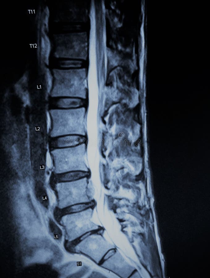 There are painful multilevel discogenic degenerative disease L4-L5 , large left central disc extrusion left L4 nerve root , bilateral foramina stenosis L5 S1., wich were revealed on MRI exam . There are painful multilevel discogenic degenerative disease L4-L5 , large left central disc extrusion left L4 nerve root , bilateral foramina stenosis L5 S1., wich were revealed on MRI exam .