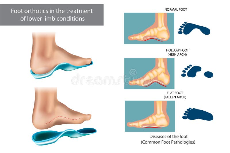 Diseases of the foot. Foot orthotics in the treatment of lower limb conditions vector illustration