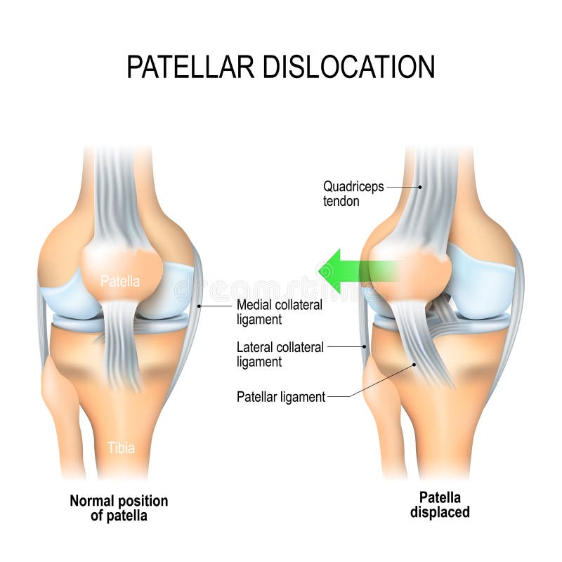 Dislocation patellaire illustration libre de droits Dislocation patellaire illustration libre de droits