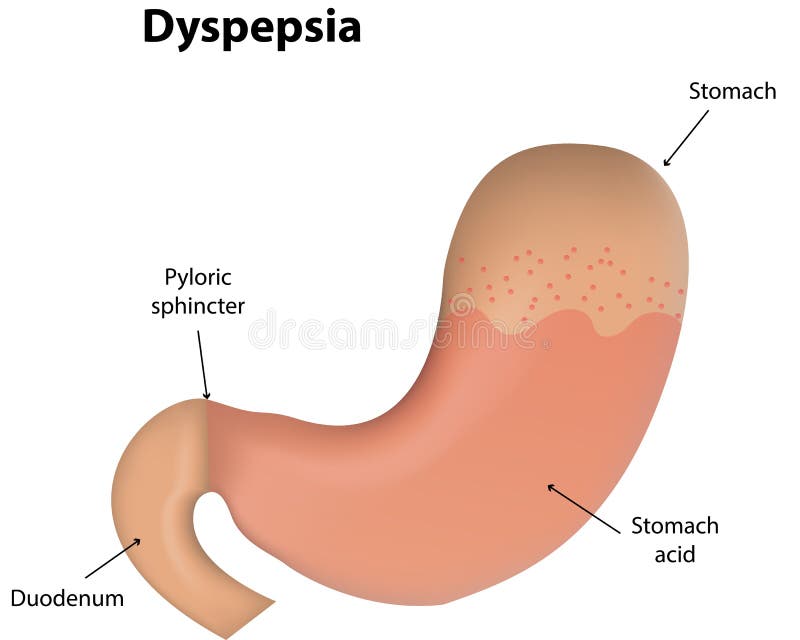 Download Dispepsia ilustración del vector. Ilustración de duodeno - 42439083