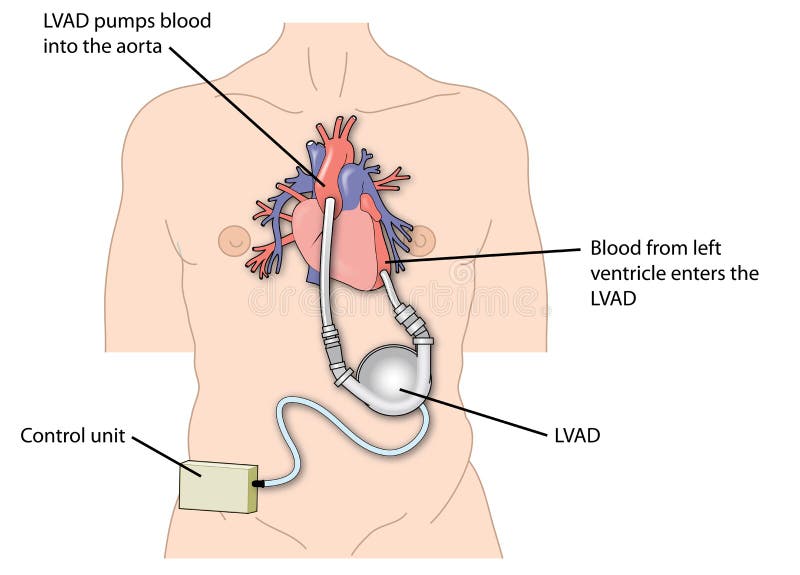 Dispositivo de ayuda ventricular izquierdo (LVAD)