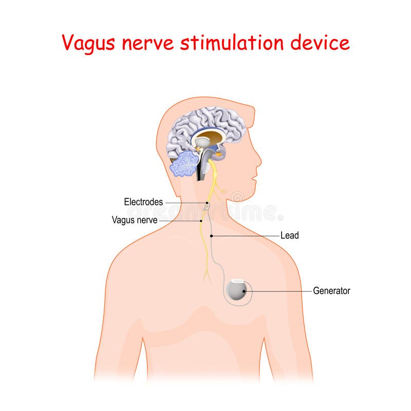 Dispositivo de estimulaciÃ³n nerviosa de Vagus