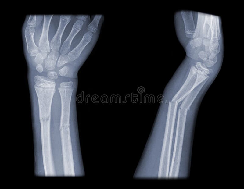 Distal arm fracture
