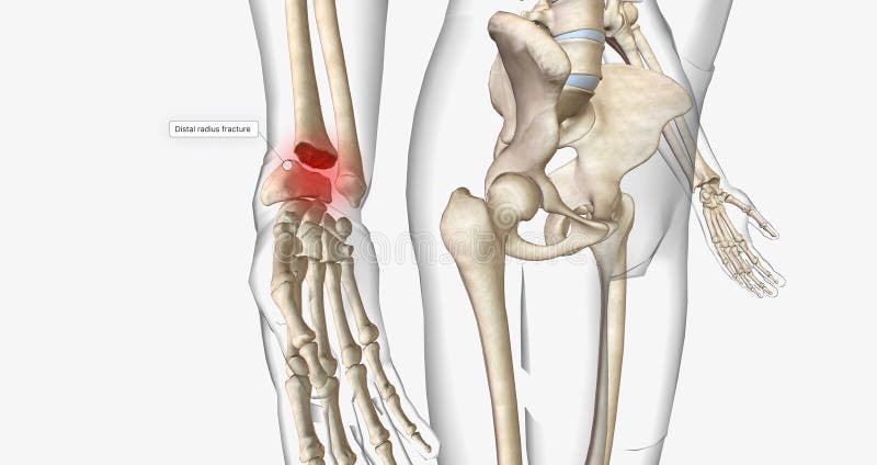 Distal Radius Fractures are among the Most Common Types of Fractures ...