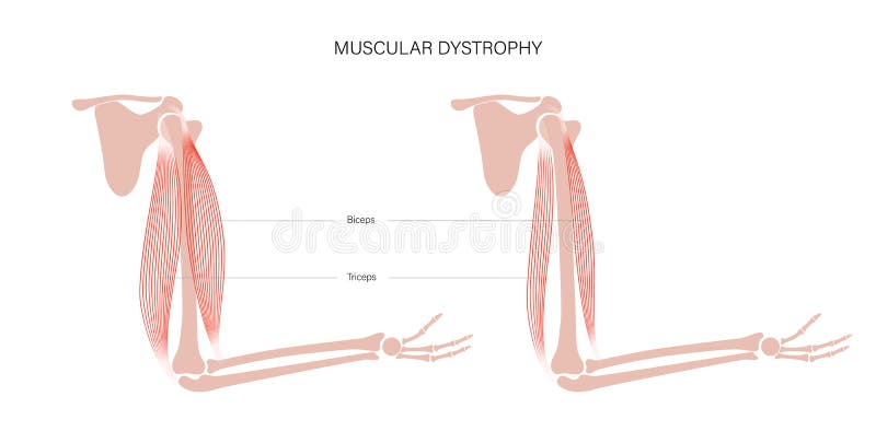 Página 10, Vetores e ilustrações de Musculos do braco para download  gratuito