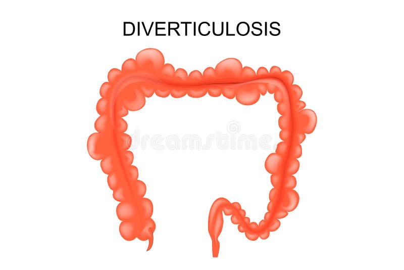 Vector illustration of diverticulosis of the colon