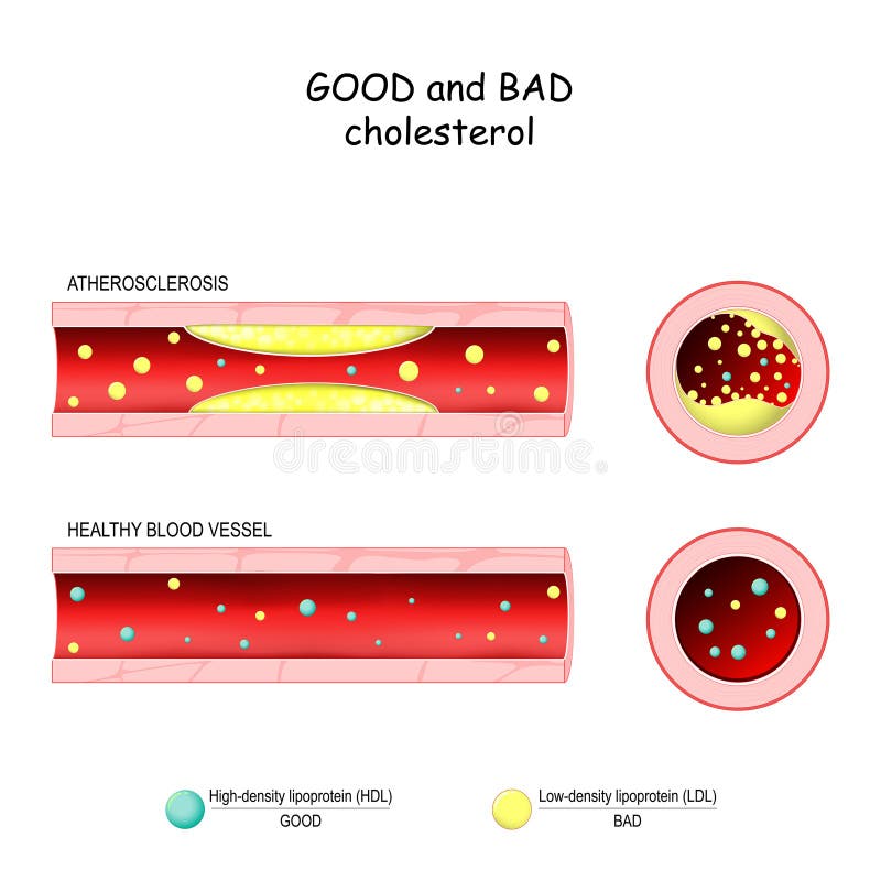 Dobry HDL i zły cholesterol LDL Zdrowe naczynie krwionośne i miażdżyca