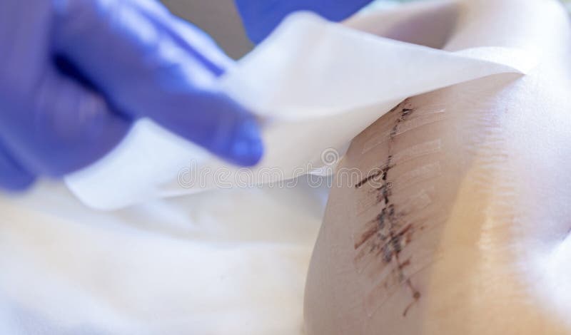Close Skin Glue On Surgical Incision Stock Photo 1330616693