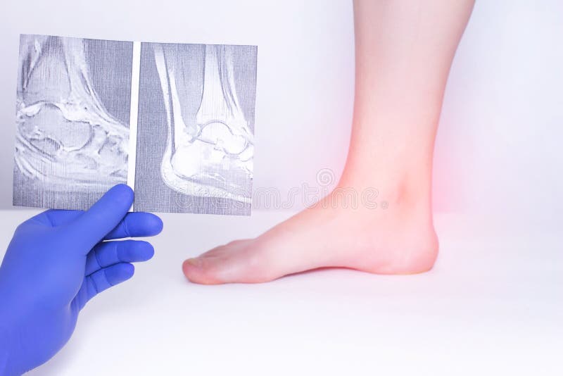 The doctor conducts a medical examination of the ankle joint using an x-ray to detect the disease of arthrosis, diagnostics royalty free stock images The doctor conducts a medical examination of the ankle joint using an x-ray to detect the disease of arthrosis, diagnostics royalty free stock images