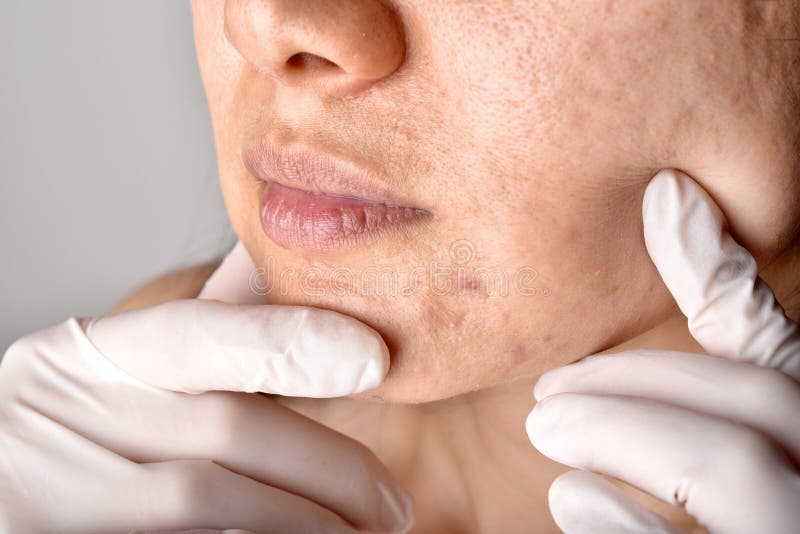 Doctor or Dermatologist hand exam patient face. Skin problems and acne scar, Acne facial care treatment