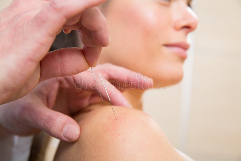 Doctor hands acupuncture needle pricking on woman royalty free stock photos Doctor hands acupuncture needle pricking on woman royalty free stock photos