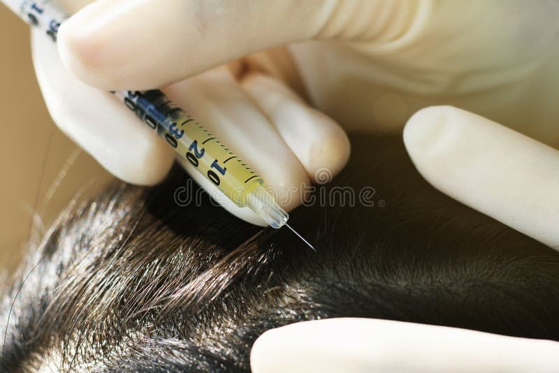 Doctor injecting at patient`s hair and scalp, Dermatologist exam scalp disorder.
