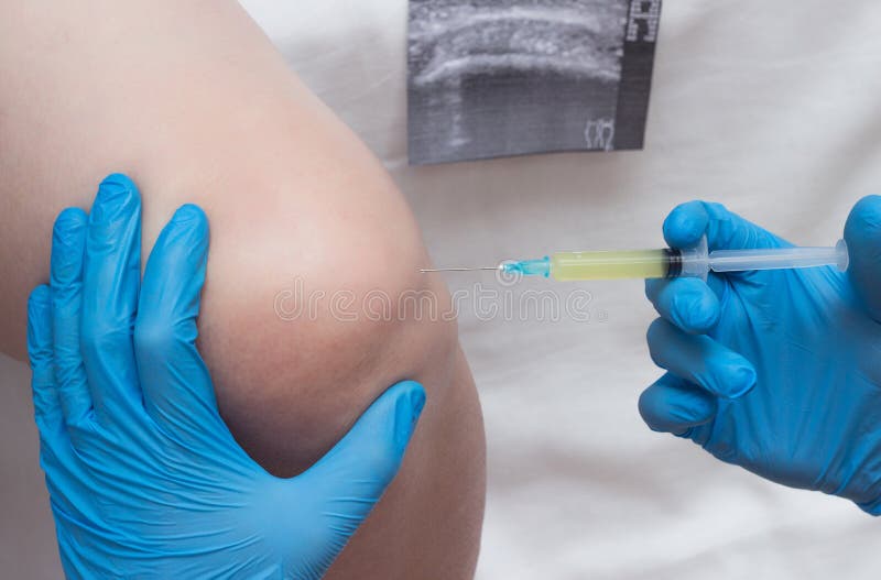 Doctor introduces blood plasma to a woman`s knee joint to treat knee sutsawa, atrita, autoplasmotherapy, close-up stock images Doctor introduces blood plasma to a woman`s knee joint to treat knee sutsawa, atrita, autoplasmotherapy, close-up stock images