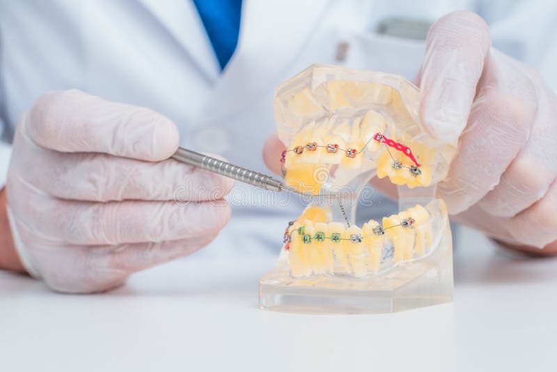 Doctor Orthodontist Shows How the System of Braces on Teeth is Arranged