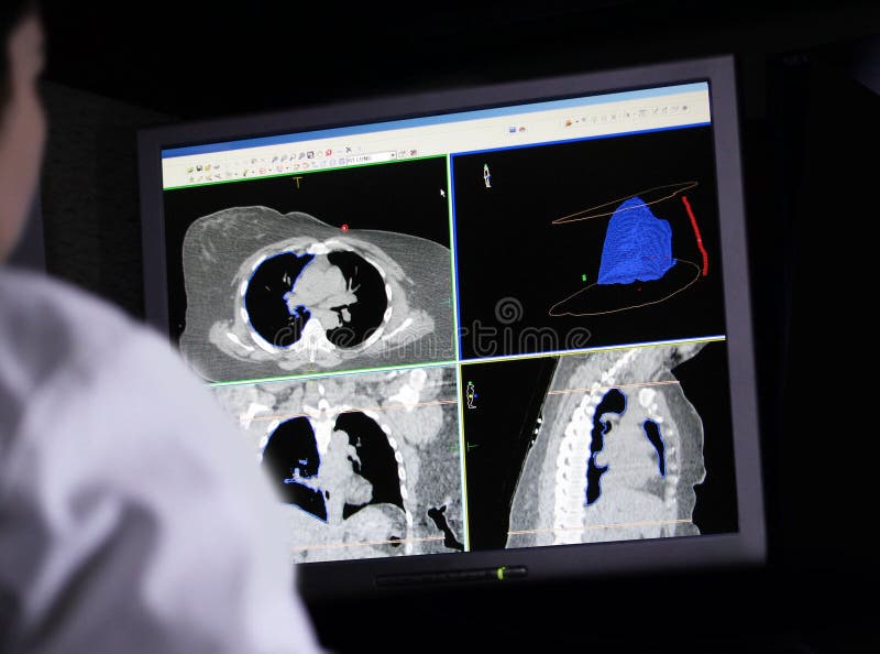 Rear view of a doctor reviewing a digital lung scan on her computer screen looking for cancer tumors. Rear view of a doctor reviewing a digital lung scan on her computer screen looking for cancer tumors