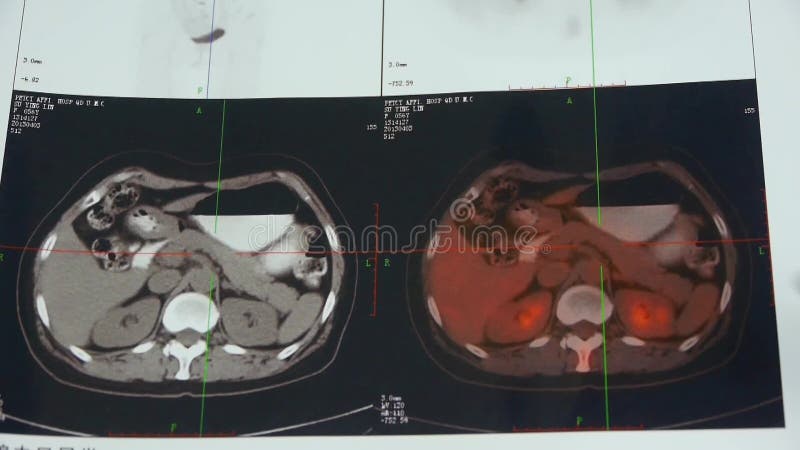 Human Pancreas or Glandular Organ Video Clip Stock Video - Video of ...