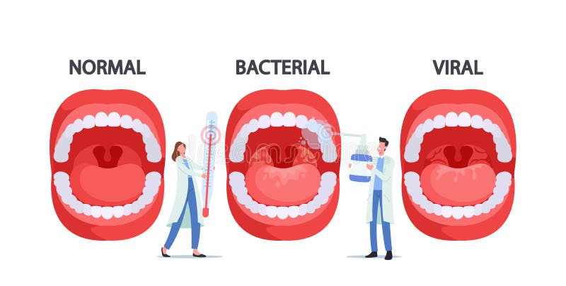 Doctors Characters with Thermometer and Spray for Throat Presenting Normal, Bacterial and Viral Pharyngitis Infection stock illustration