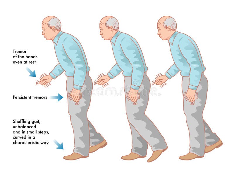 Doença de Parkinsons ilustração stock Doença de Parkinsons ilustração stock