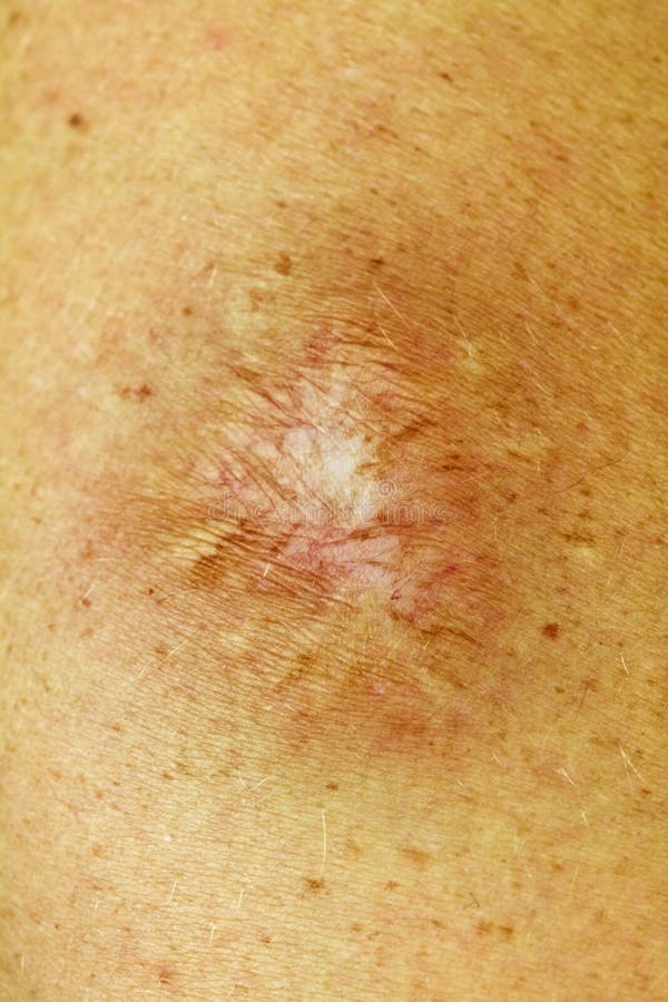 Dog Bite Scar stock photo. Image of stitches, wound, medicine 21044966