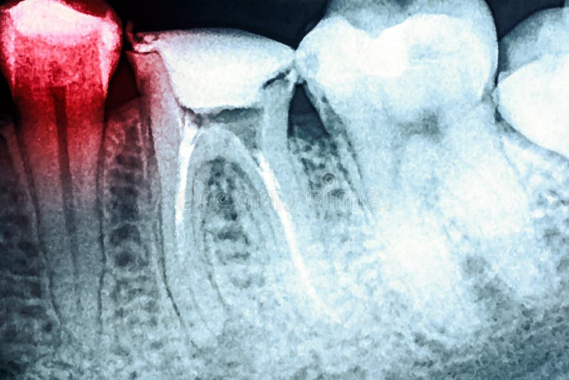 Dolore di carie dentaria sui raggi x
