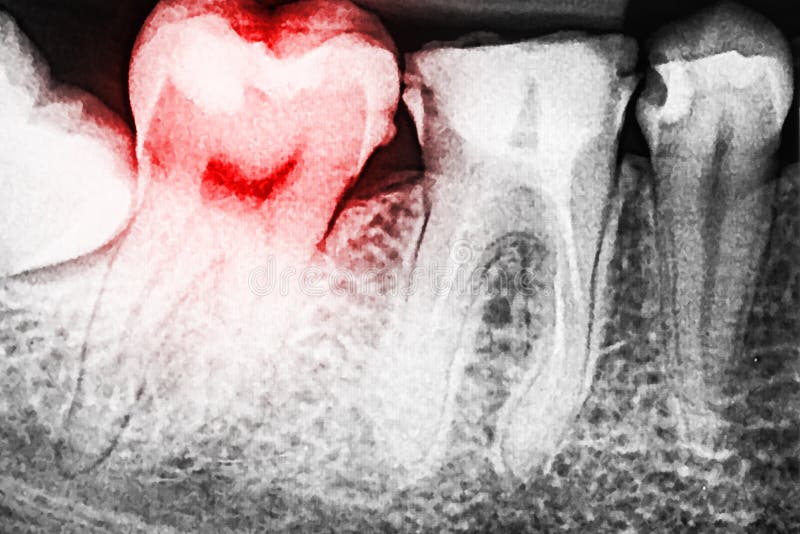 Dolore di carie dentaria sui raggi x