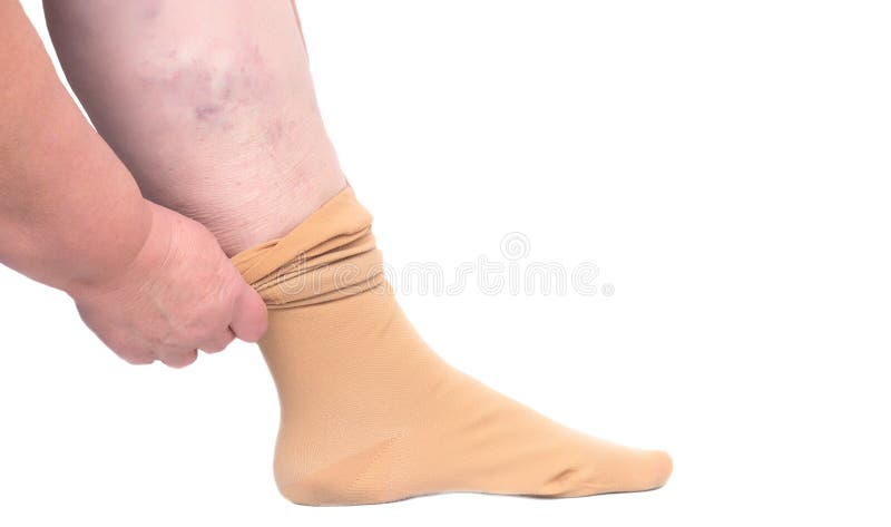 Donna che mette sulla calza medica della gamba per le vene varicose sulle gambe, fondo bianco, isolato, primo piano, phlebeurysm