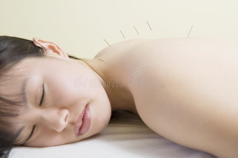 Donna che si trova con gli aghi di agopuntura in lei indietro immagine stock libera da diritti Donna che si trova con gli aghi di agopuntura in lei indietro immagine stock libera da diritti