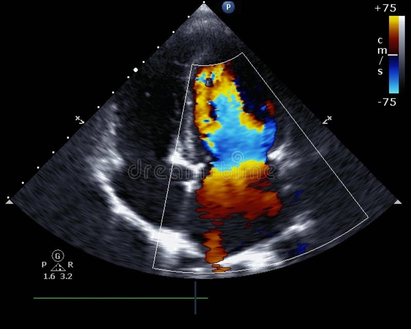 Doppler echocardiography stock photos Doppler echocardiography stock photos