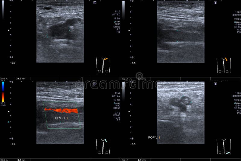 Close up Doppler Ultrasound of Deep Vein Thrombosis Superficial Femoral Vein left thigh Medical healthcare concept