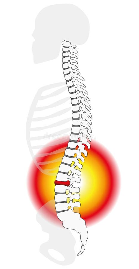 Dordzeniowy dyska Prolapse Herniation royalty ilustracja Dordzeniowy dyska Prolapse Herniation royalty ilustracja