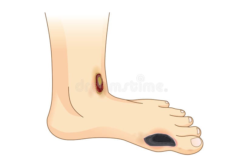 Douleur et ulcères diabétiques de pied illustration libre de droits Douleur et ulcères diabétiques de pied illustration libre de droits