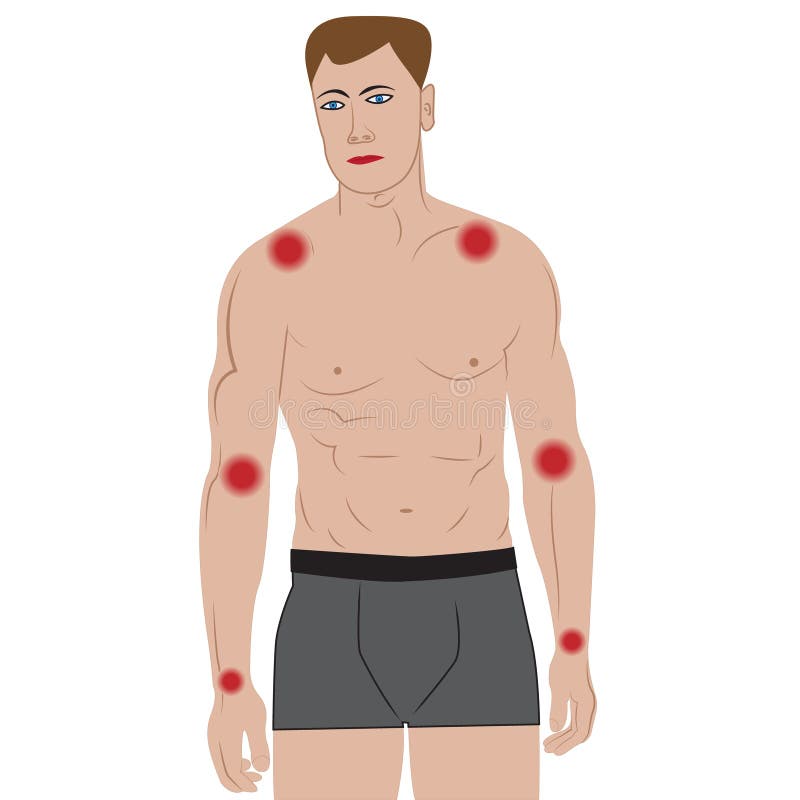 Douleurs articulaires dans des bras de corps masculin infectée ou de blessure illustration stock Douleurs articulaires dans des bras de corps masculin infectée ou de blessure illustration stock