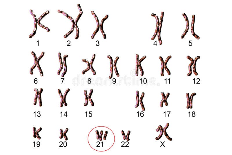 Down-syndrome karyotype stock illustration. Illustration of macro - 81631766